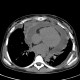 Pericardial effusion, anemia: CT - Computed tomography